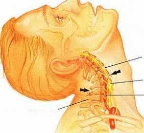 Причины шейного остеохондроза
